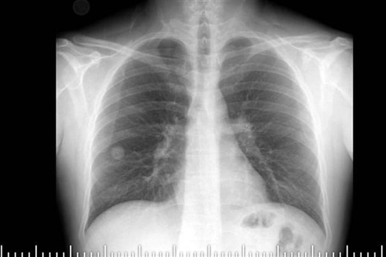 Kanser şüphesiyle ameliyat oldu Akciğerinden böcek çıktı