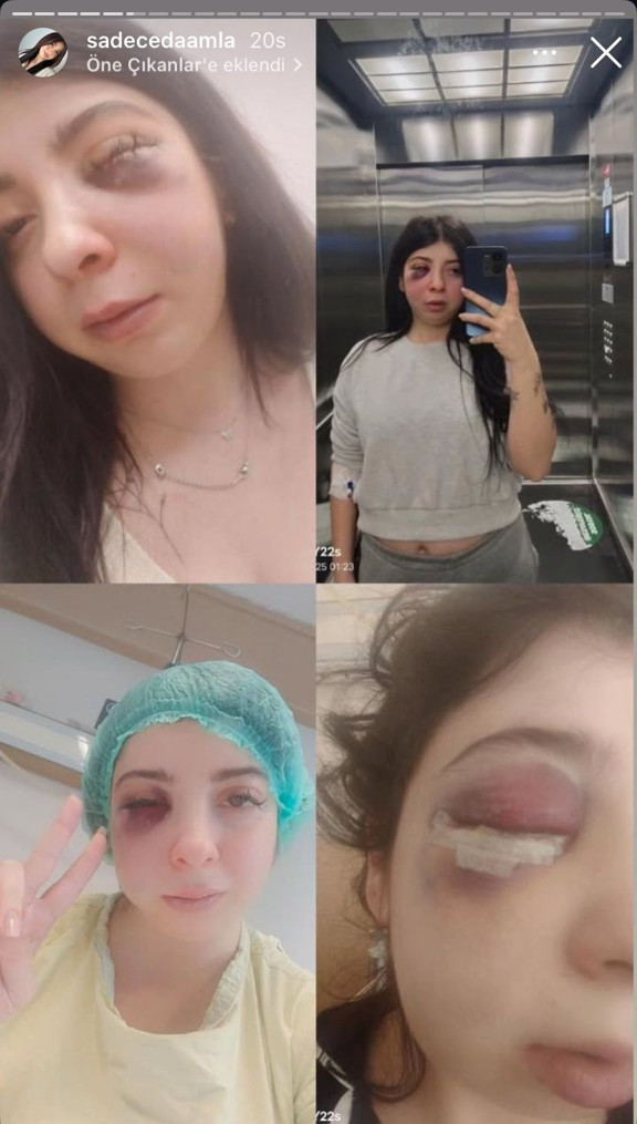 Samsunda yolda yürürken sözlü tacize uğradı, darbedildi Yaşadığı dehşeti anlatan Damla Korkmaz: Artık yüzümün sol tarafını hissetmiyorum