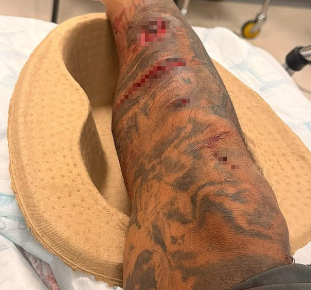 Liverpool'un eski yıldızı Jermaine Pennant, köpek saldırısı sonucu bacağına 50 dikiş atıldı.