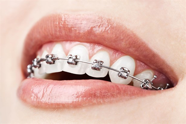 Sadece Birkaç Ay Süren Diş Teli Tedavisi: Fastbraces