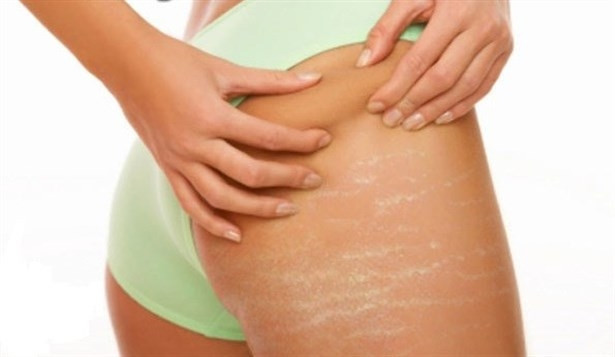 Vücut Çatlakları Nasıl Geçer