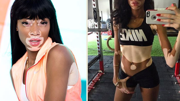 Hastalığını avantaja çevirdi: Winnie Harlow