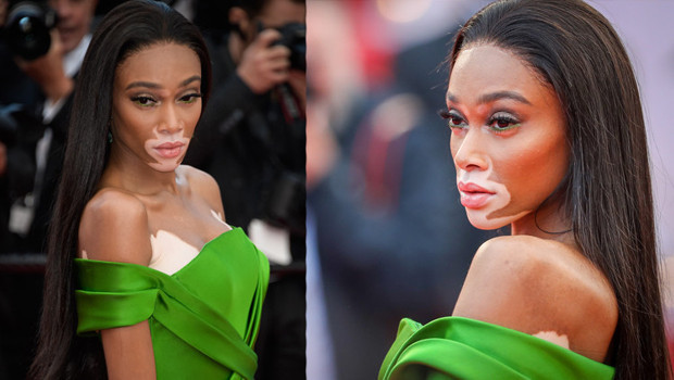 Winnie Harlow kimdir Winnie Harlow kimdir