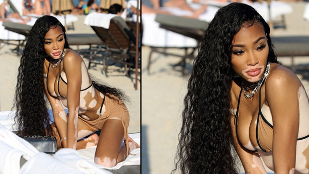 Winnie Harlow: Küçükken alay ederlerdi, şimdi milyon dolarlık servetin sahibi Winnie Harlow: Küçükken alay ederlerdi, şimdi milyon dolarlık servetin sahibi