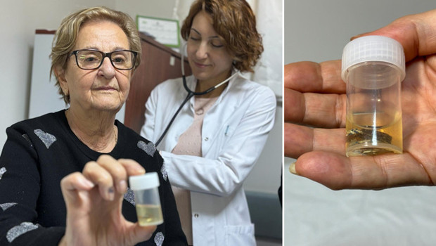 Antalya'da ilginç olay! Hapı alüminyum kabıyla yuttu, 4 yıl sonra akciğerinden bütün halinde çıkarıldı... 'Meğer hapı yutmuşum'