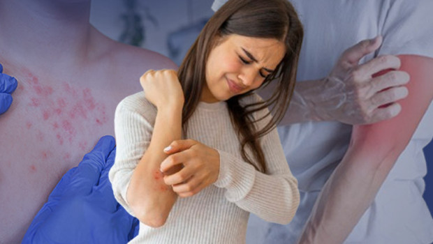 Acil servislerde yoğunluk arttı: Sessizce yükselen uyuz tehlikesi! ‘Genellikle bu iki şikâyetle başvuruyorlar’ | NASIL ÖNLEM ALINMALI?