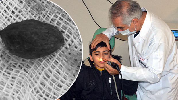 Kaşıntı şikayetiyle hastaneye gitti: Burnundan çıkanlara ailesi şaşırdı! 'Ameliyatta karşılaştık'