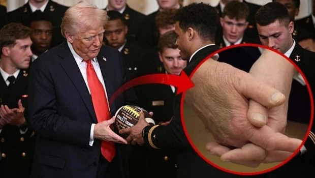 Trump, elindeki morlukların sebebini açıkladı