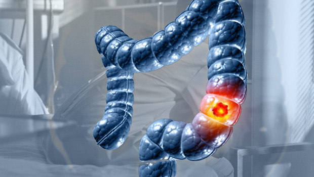 Uzmanlar şokta! Çok kısa sürede en ölümcül kanser oldu: Bu kadar hızlı ilerlemesini bilim insanları da beklemiyordu