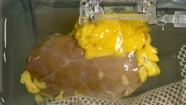 Böbrek naklinde uyuşma sorunu ortadan kalkabilir