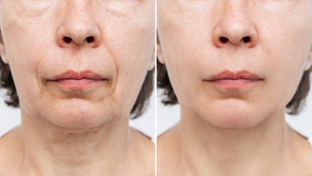 Botoks ve dolguya alternatif: Sıvı yüz germe! Yüzünüzü doğal yolla canlandırmanın yolu