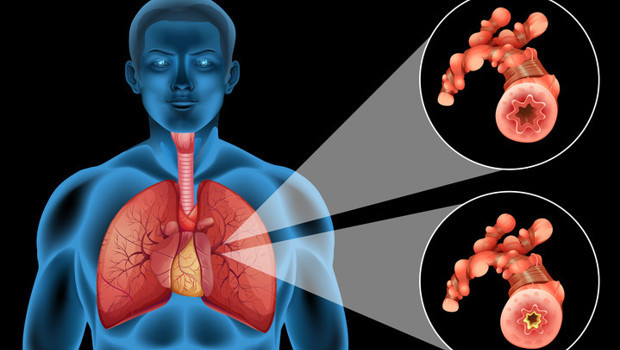 Bir anda başlıyor, hızla nefesi kesebiliyor! Özellikle 15 – 30 yaş grubundaki erkekler risk altında