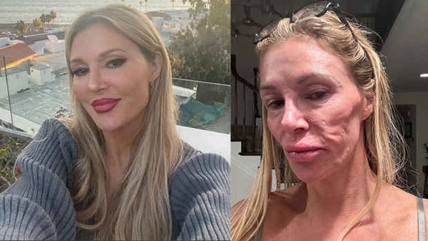 Güzellik hevesi kabusla bitti… Yüzü tanınmaz hale geldi: Bir gecede 20 yıl yaşlandım