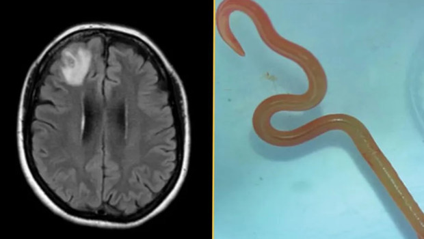 Tıpta görülmemiş vaka: Beyninden canlı solucan çıktı!
