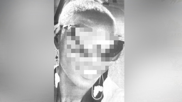 Başarısız saç ekimine 4 milyon liralık dava