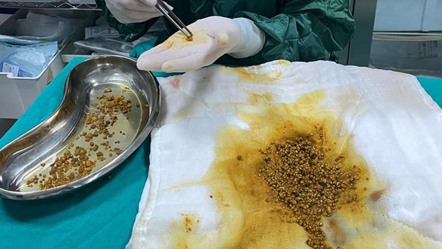 Karın ağrısı şikayeti ile gitti, sebebini öğrenen doktorlar bile şaşkına döndü