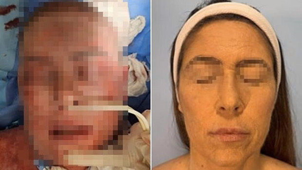 Depresyon ilacı kabusu: Yüzü tanınmaz hale geldi, 66 gün hastanede kaldı