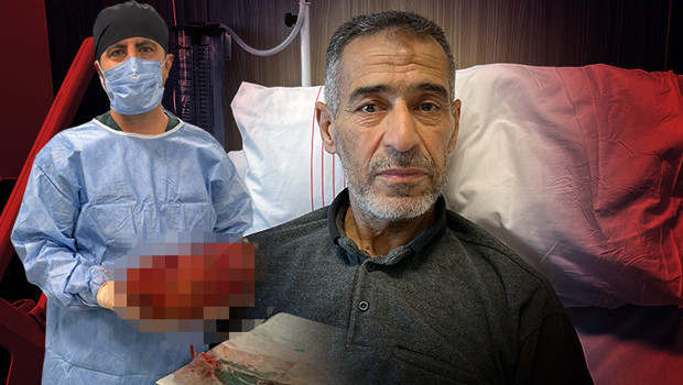 Ağrı şikayeti ile gitti, varılan teşhis doktorları da hayrete düşürdü | Normalde yarım kilo olması gerekirken 8 kiloya ulaşmıştı