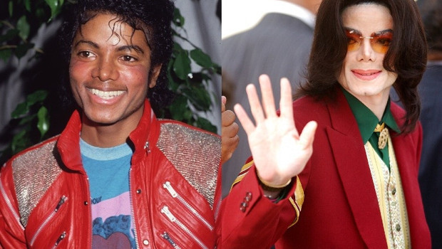 Michael Jackson’ın görüntüsünü değiştiren hastalık yeniden gündemde: Vitiligo nedir, kimleri etkiler?