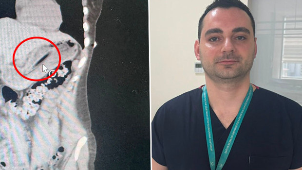 Kilo vermek için yaptı, ameliyata alındı! Doktorlar hayrete düştü: '13 santimetrelik cisim nasıl yutulur?'