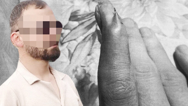 Çıkarılamayan iğne için ihmal davası