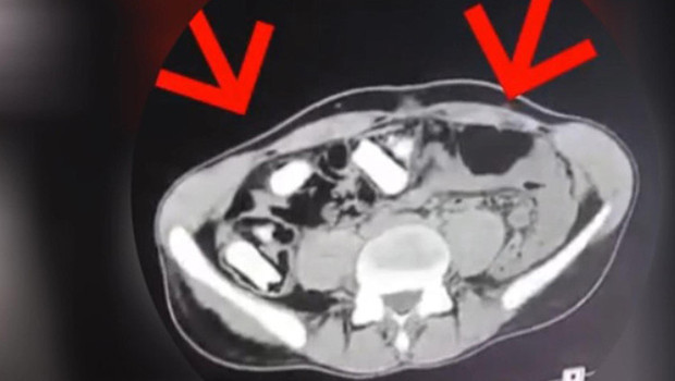 Röntgen çekilince ortaya çıktı: Midesinde kurye gibi uyuşturucuyu taşıyan şüpheli tutuklandı