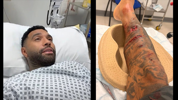Liverpool'un eski yıldızı Jermaine Pennant'a köpek saldırdı! Bacağına 50 dikiş atıldı