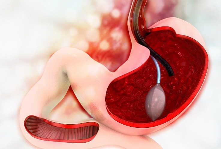 Yutulabilir Mide Balonu Nedir, Nasıl Yapılır?