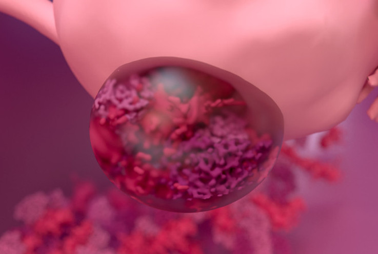 Miyomlar kansere dönüşebilir mi? 10 soruda miyom gerçeği