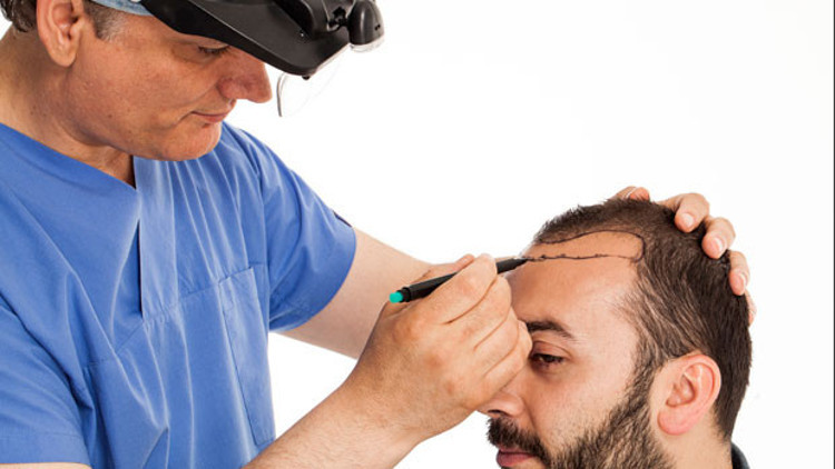 Saç ektirdiğim anlaşılır mı