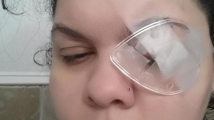 Simli göz farı genç kadını gözünden etti