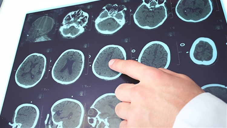 Çocuklarda epilepsi tedavisinde ilaç kullanımı nasıl olmalı