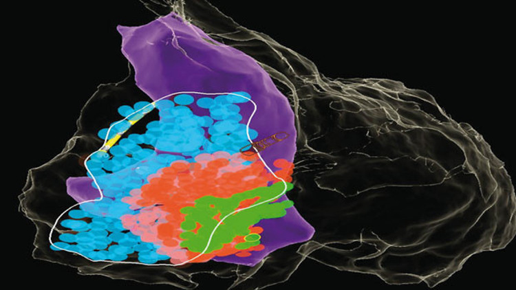 Duran kalp radyo dalgasıyla çalıştırıldı