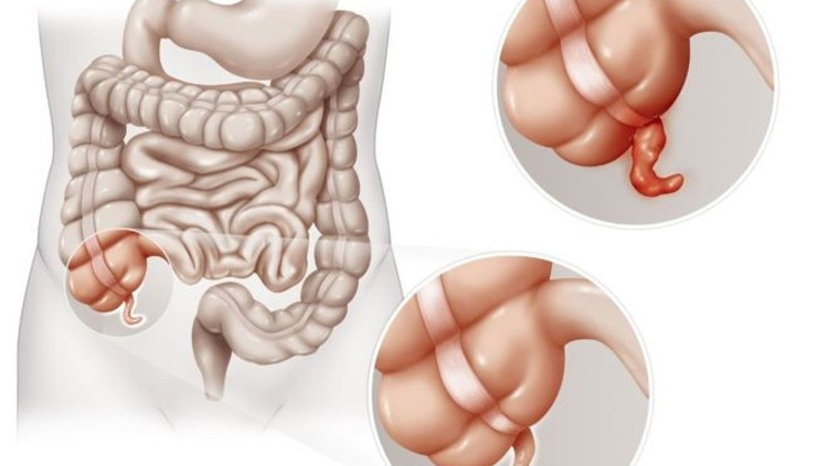 Apandisti alınanların Parkinsona yakalanma riski daha az Apandisti alınanların Parkinsona yakalanma riski daha az