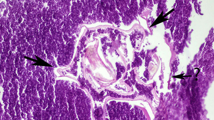 Kanser şüphesiyle ameliyat oldu Akciğerinden böcek çıktı Kanser şüphesiyle ameliyat oldu Akciğerinden böcek çıktı