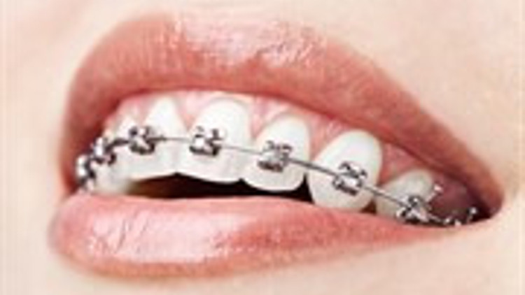 Sadece Birkaç Ay Süren Diş Teli Tedavisi: Fastbraces