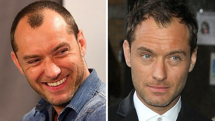 Saç Ekim Sonrası Ne Zaman Denize Girilebilir