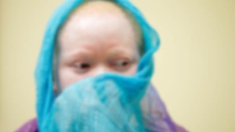 Zambiya’da albinos çocuğun elini kestiler Zambiya’da albinos çocuğun elini kestiler
