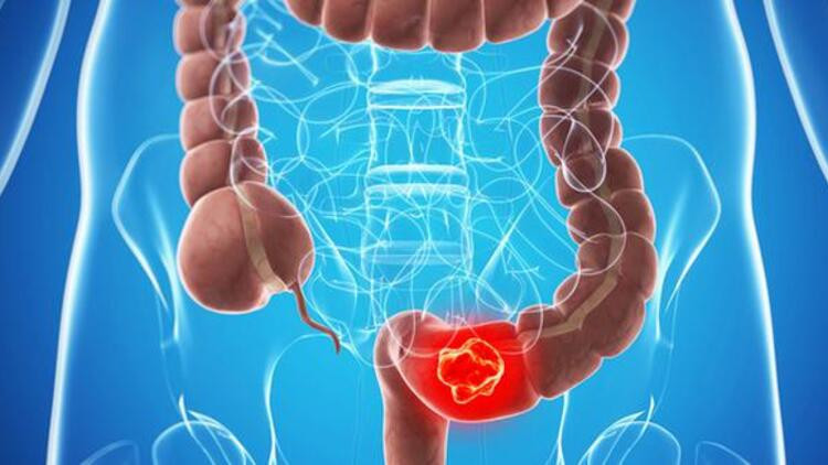 Kolon kanseri nedir, ne kadar sürer Kolon kanseri belirtileri neler