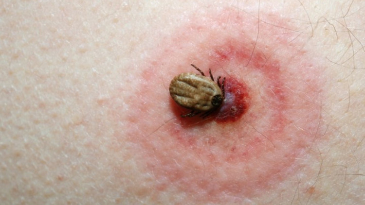 Lyme hastalığı nedir Belirtileri ve tedavi yöntemleri nelerdir