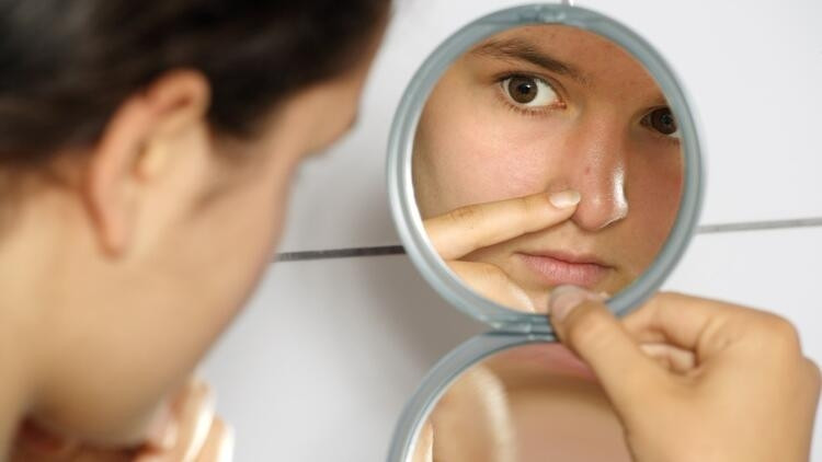 Sivilce izleri nasıl geçer Sivilce lekeleri için doğal yöntemler