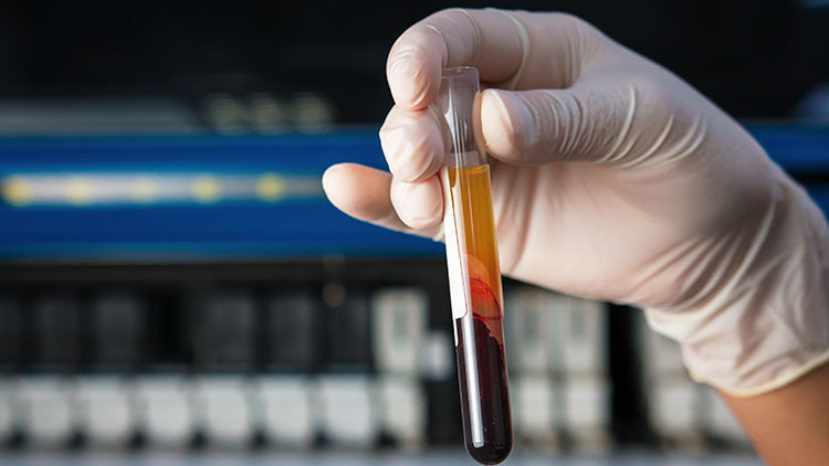 Inr nedir Inr değeri kaç olmalıdır Düşüklüğü ile yükseliği nedenleri ve belirtileri Inr nedir Inr değeri kaç olmalıdır Düşüklüğü ile yükseliği nedenleri ve belirtileri