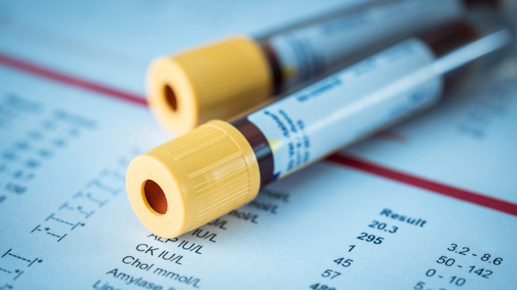 AFP testi nedir AFP değeri kaç olmalıdır Düşüklüğü ile yükseliği nedenleri ve belirtileri