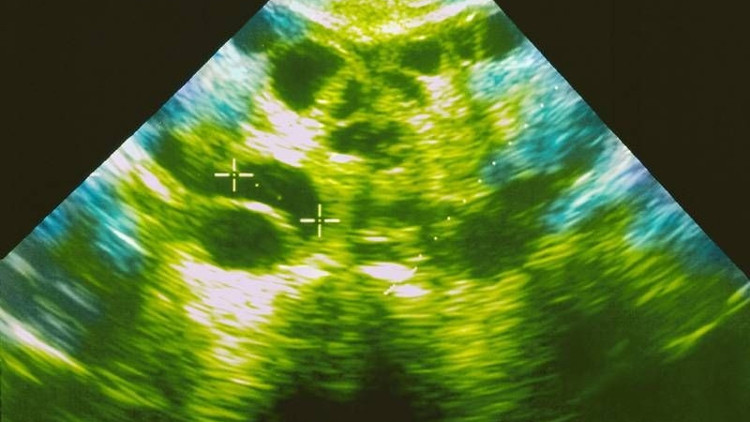 Bu hastalık gebe kalmayı zorlaştırıyor