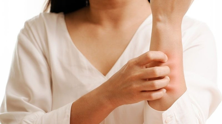 Ürtiker neden olur Belirtileri, çeşitleri, tedavisi