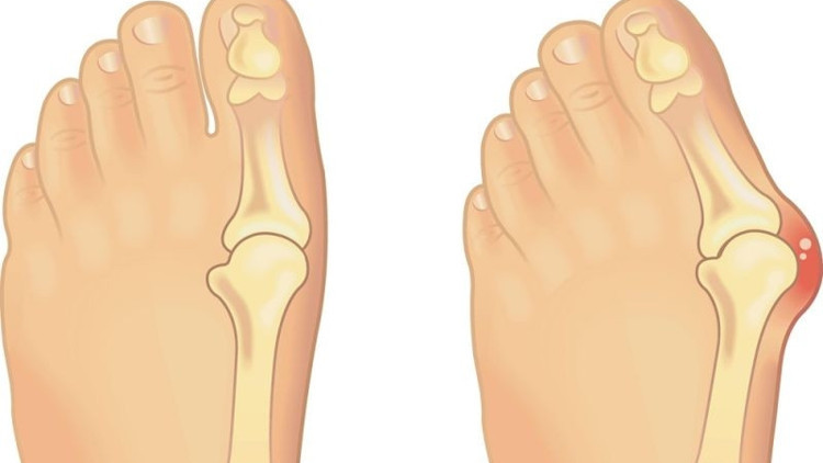 Bünyonlarınızı ameliyatsız küçültmenin 6 kolay yolu Bünyonlarınızı ameliyatsız küçültmenin 6 kolay yolu