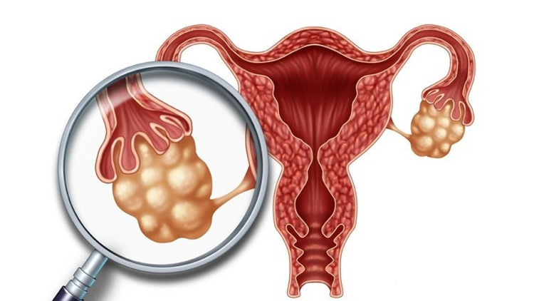 Polikistik Over Sendromu nedir PKOS hastaları hamile kalabilir mi Polikistik Over Sendromu nedir PKOS hastaları hamile kalabilir mi