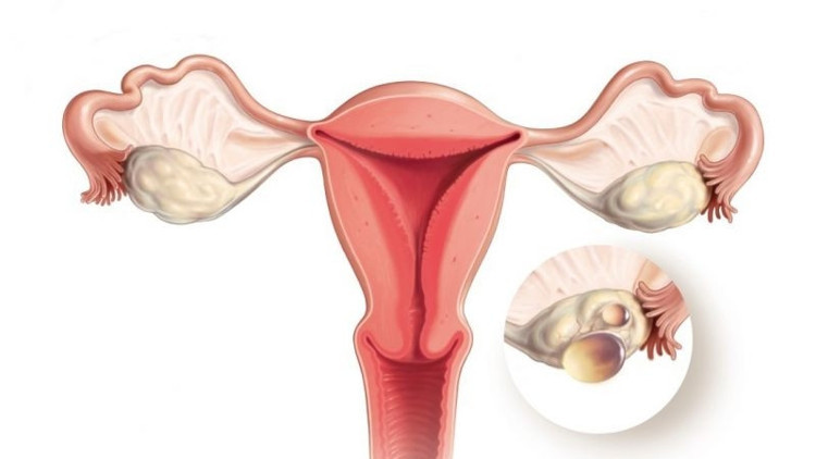 Polikistik over sendromu uzun dönemde sağlık sorunlarına sebep olur mu