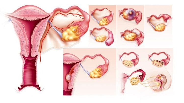 Yaşam tarzınızı değiştirin, polikistik overi yenin Yaşam tarzınızı değiştirin, polikistik overi yenin