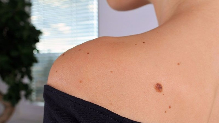 Aniden büyüyen benlere dikkat